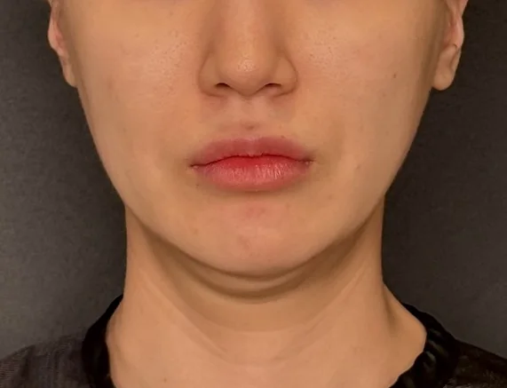 압토스 시술 전